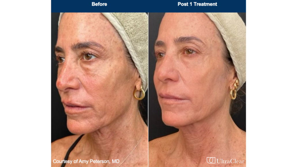 Ultraclear Laser Skin Rejuvenation Solutions