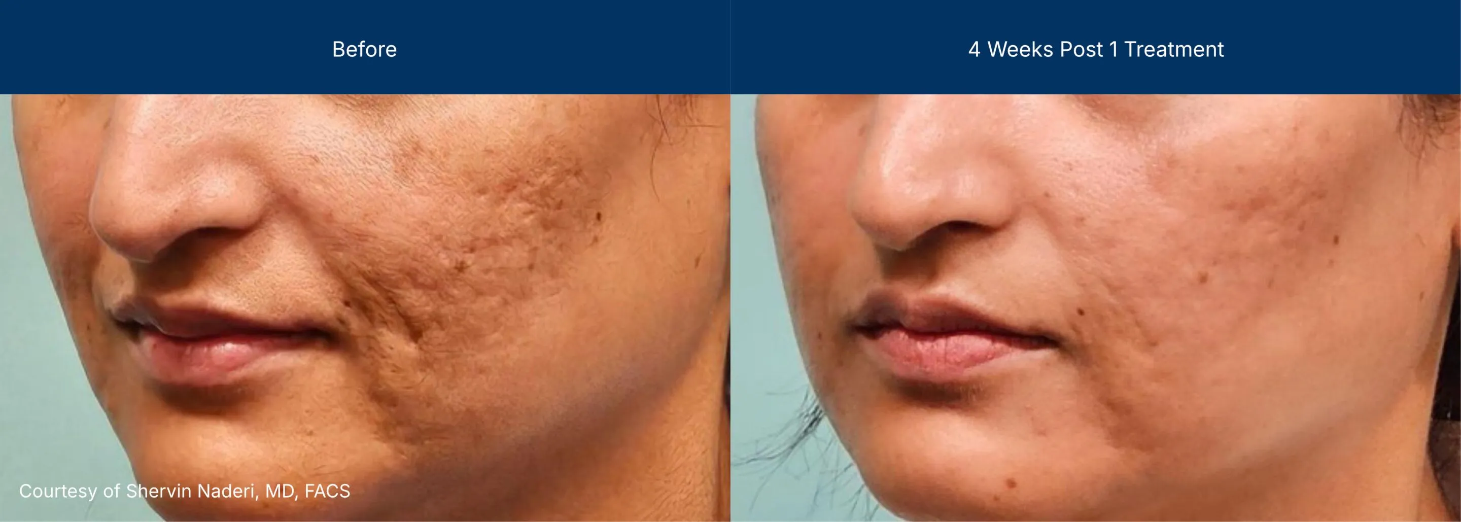 Moderate Treatment before and after photos of a female patient
