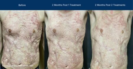 Ultraclear before and after