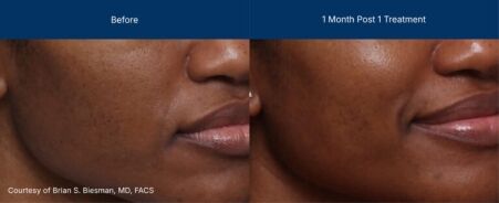 3dmiracl before and after