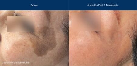 Ultraclear before and after photos
