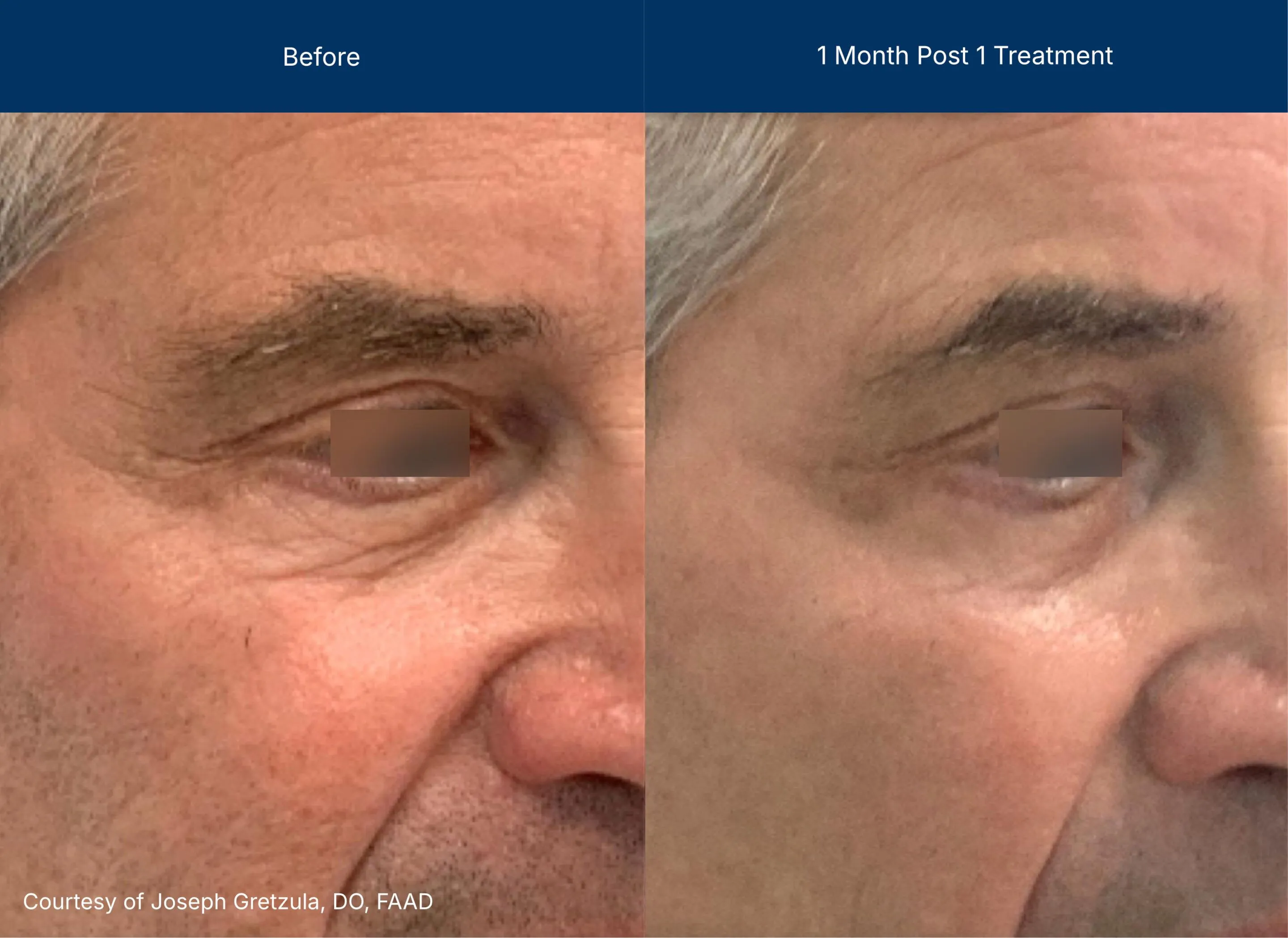 UltraClear before and after photos