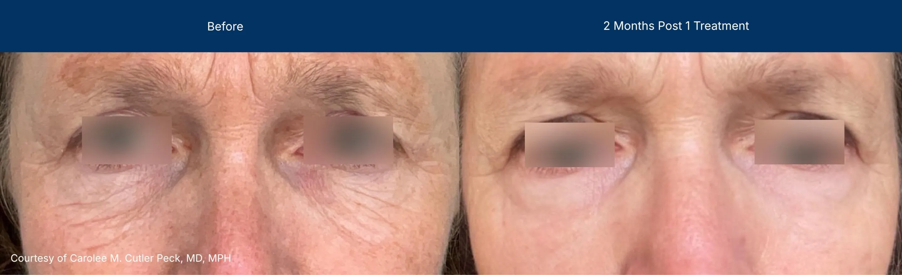 Ultraclear and laser coring before and after photos