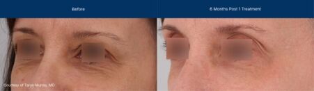Ultraclear and laser coring before and after photos