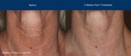 3dmiracl before and after photos