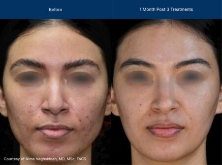 Superficial treatment Before and after photos of a female patient