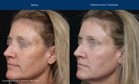 Ultraclear before and after photos