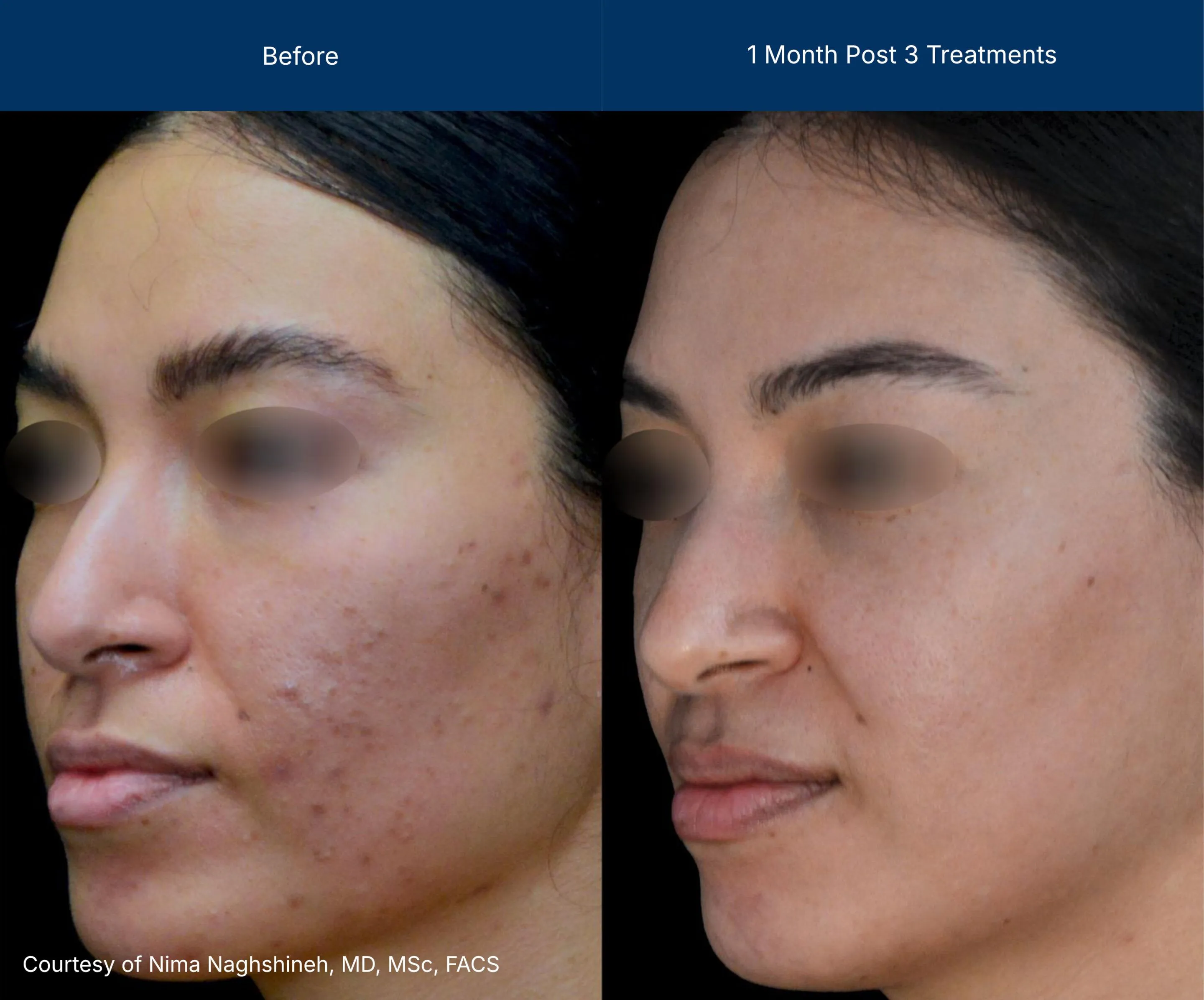 Superficial treatment Before and after photos of a female patient