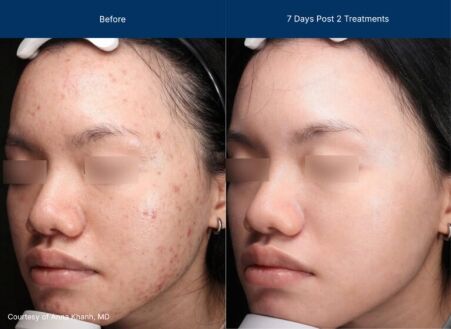 Moderate Treatment before and after photos of a female patient
