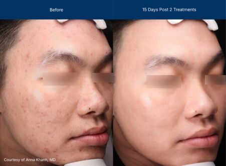 Moderate Treatment before and after photos of a male patient