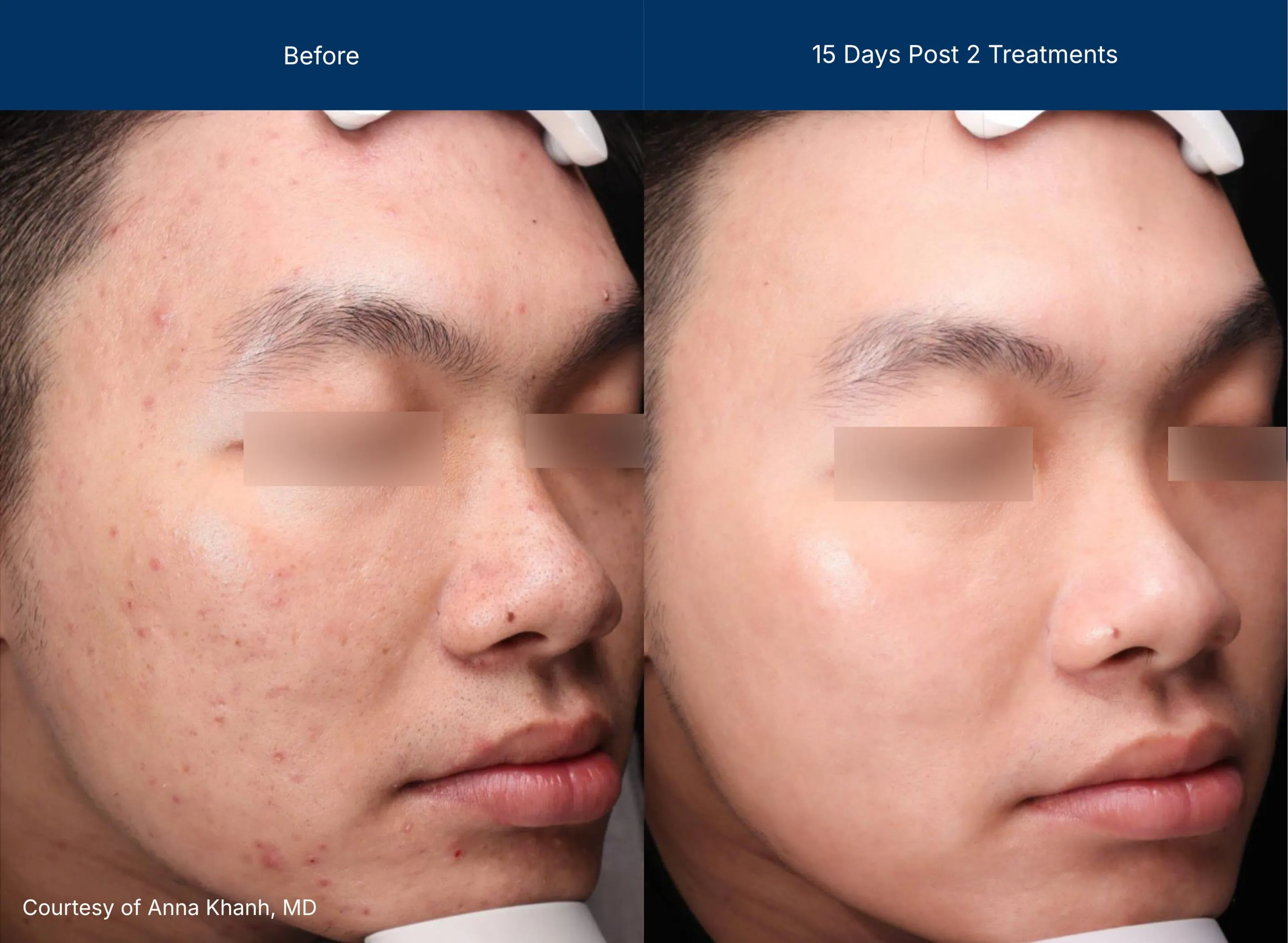 Moderate Treatment before and after photos of a male patient