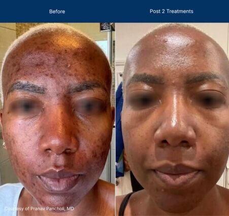 Moderate Treatment before and after photos of a female patient