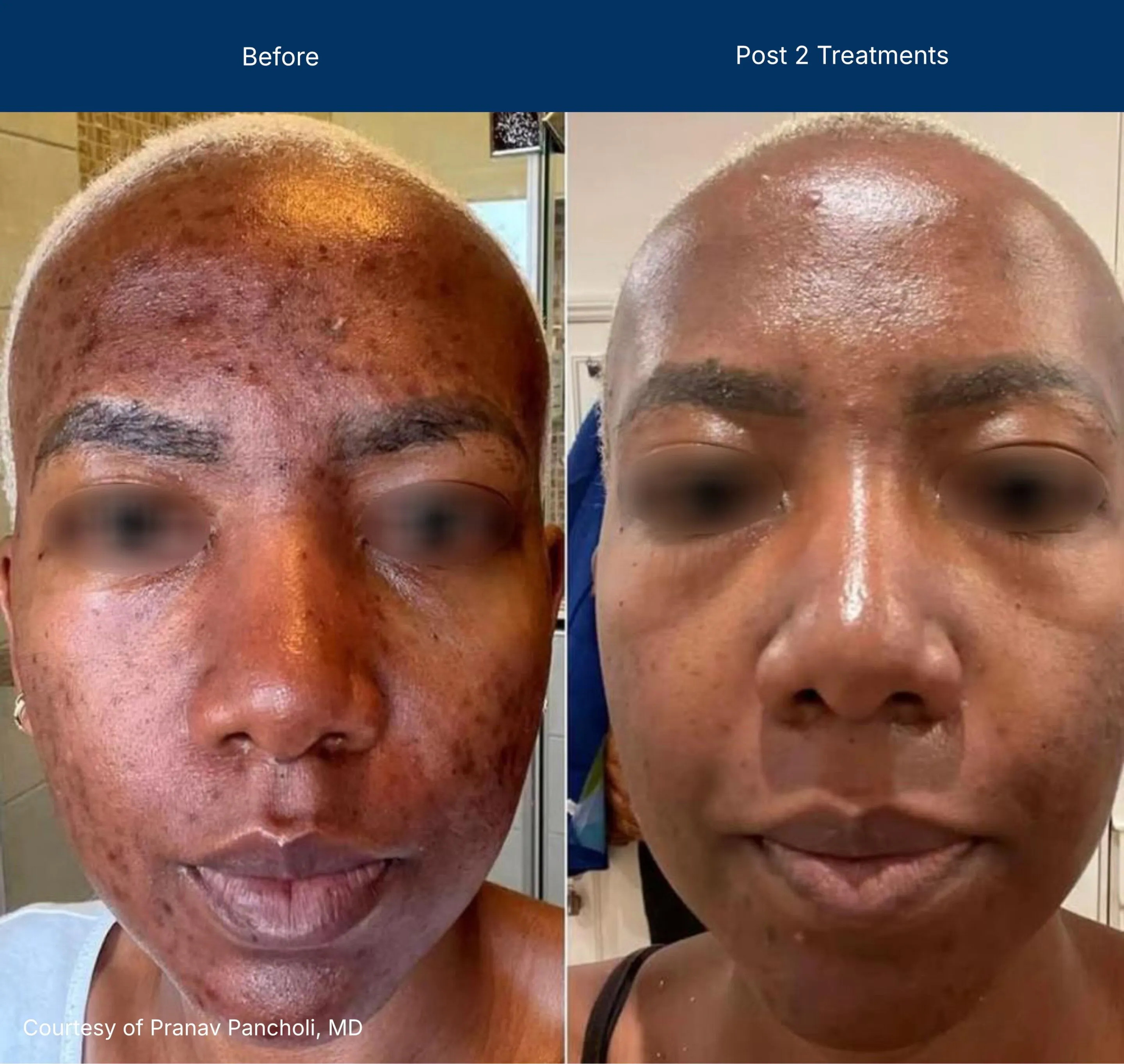 Moderate Treatment before and after photos of a female patient