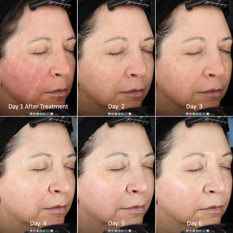 UltraClear Laser Results