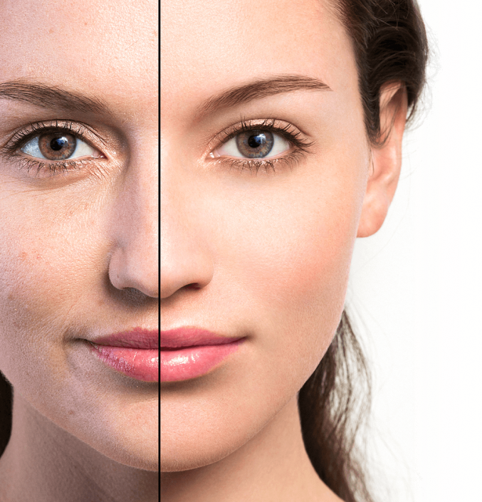 UltraClear Laser Skin Rejuvenation Solutions