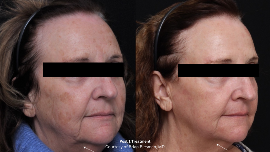 UltraClear Laser Skin Rejuvenation Solutions