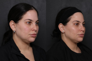 UltraClear Laser Results: Before and After, Angle View