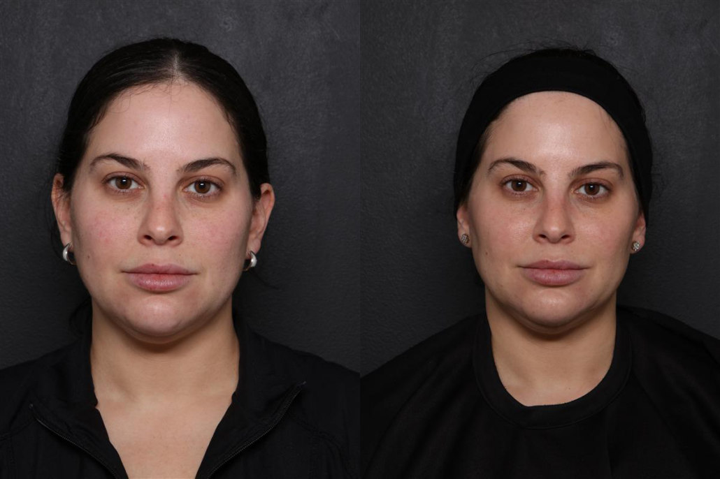 UltraClear Laser Results: Before and After, Front View