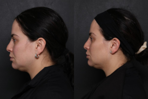 UltraClear Laser Results: Before and After, Side View
