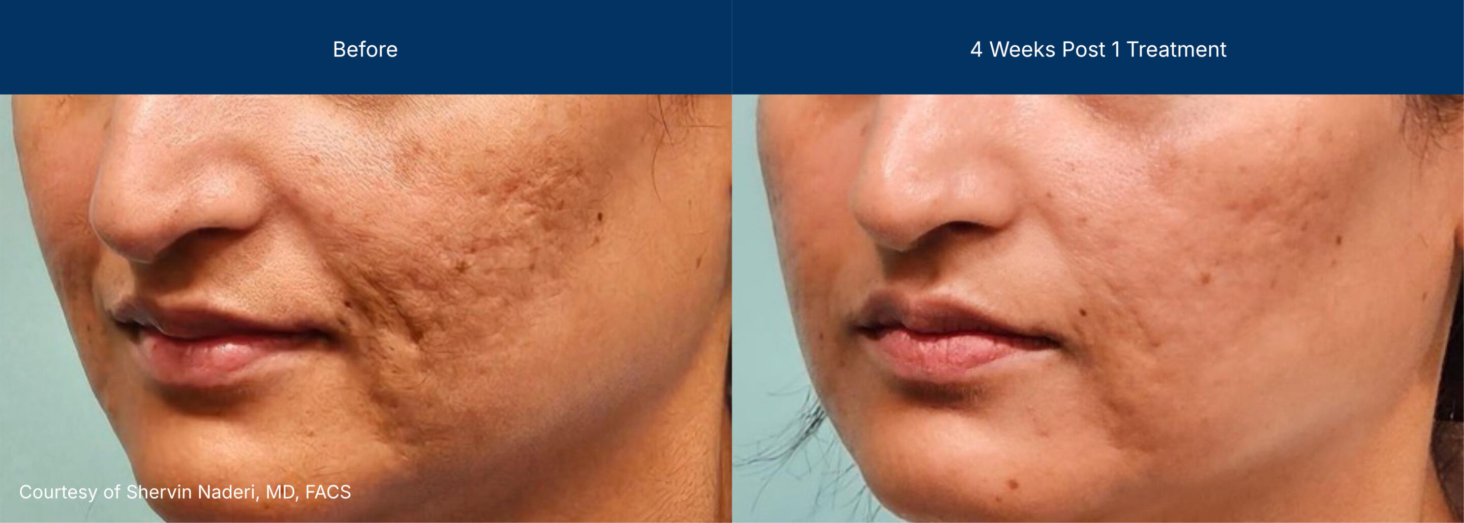 Moderate Treatment before and after photos of a female patient