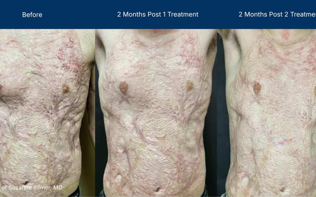 Moderate Treatment