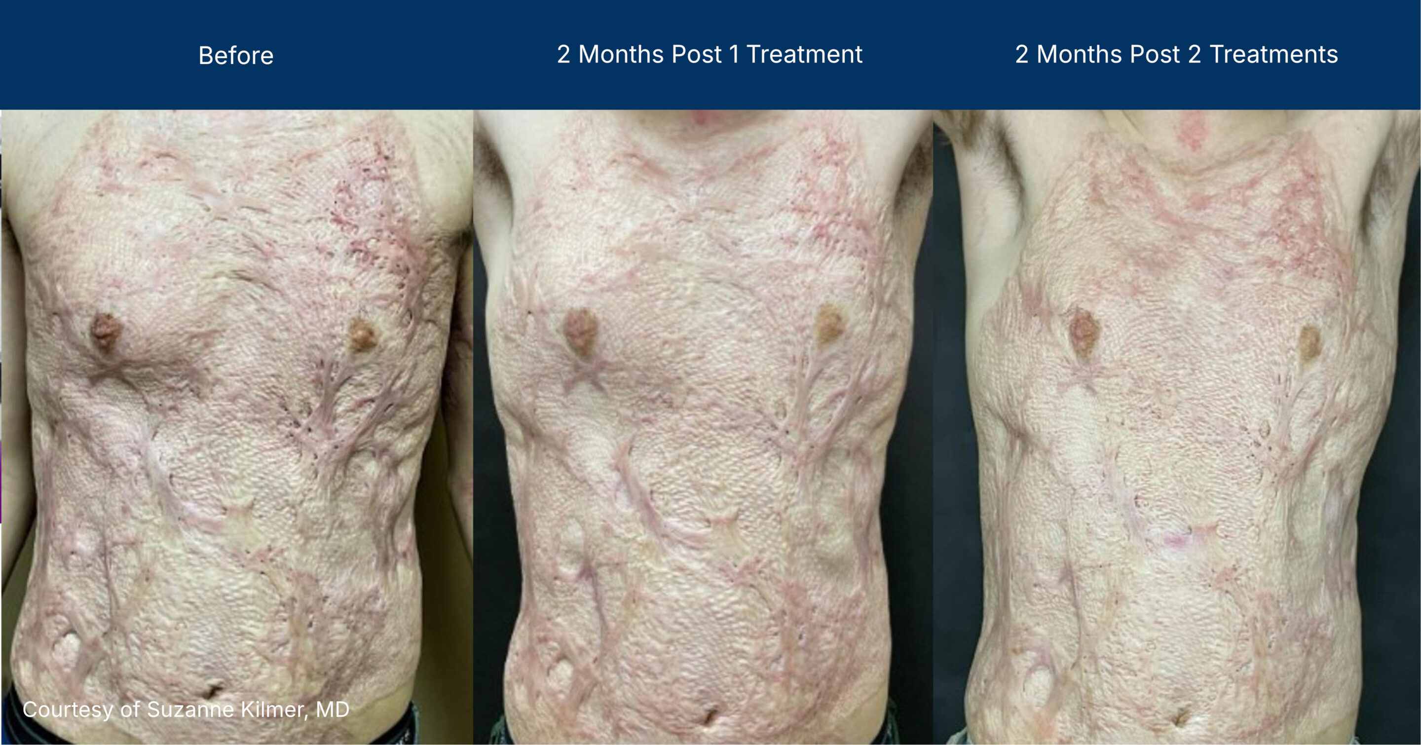 Ultraclear before and after