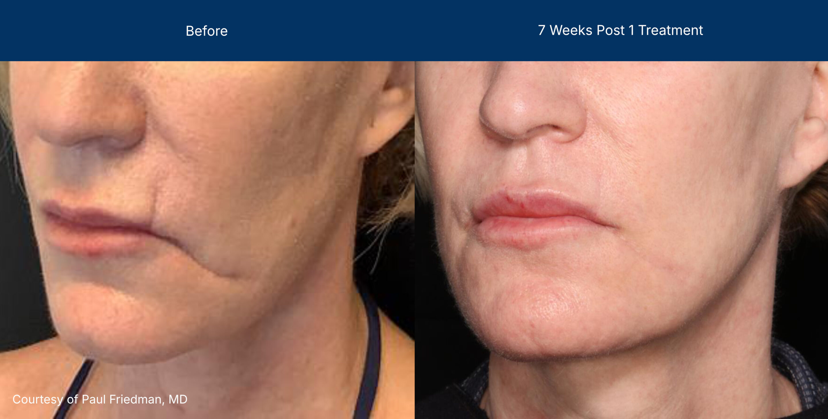 Ultraclear before and after