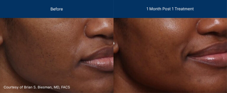 3dmiracl before and after