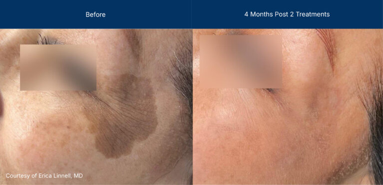 Ultraclear before and after photos