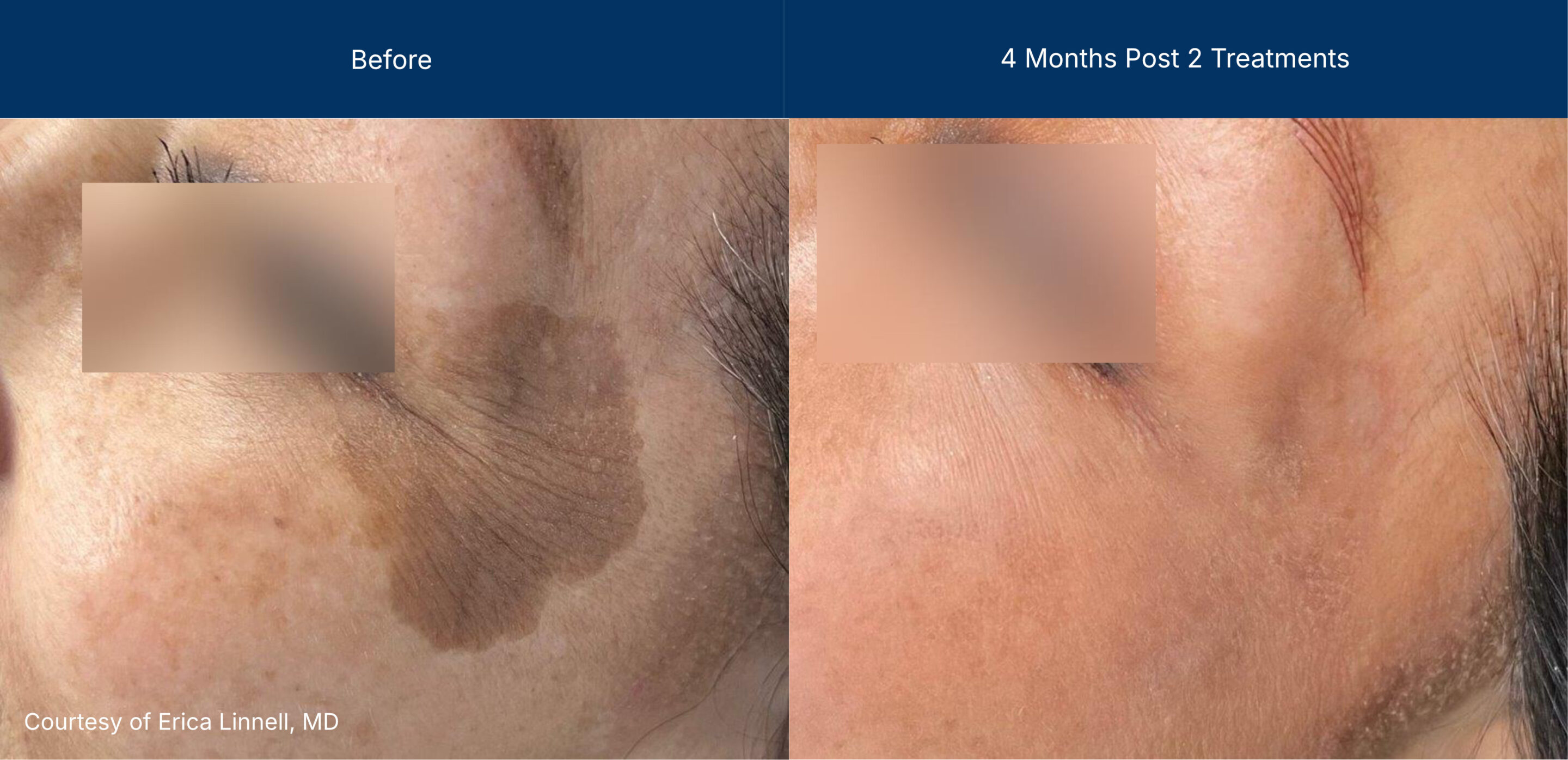 Ultraclear before and after photos