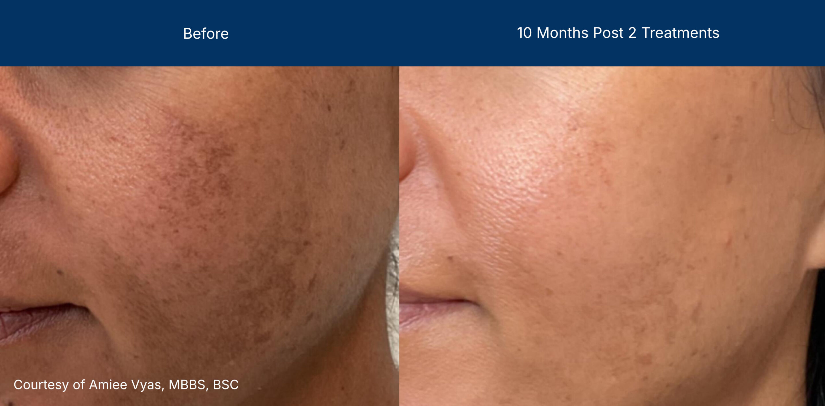 Ultraclear/3dmiracl before and after photos