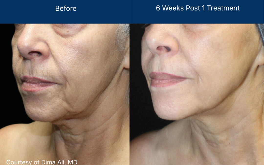 Advanced Treatment