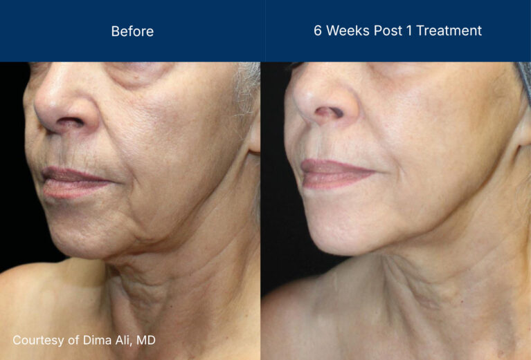 Ultraclear before and after photos