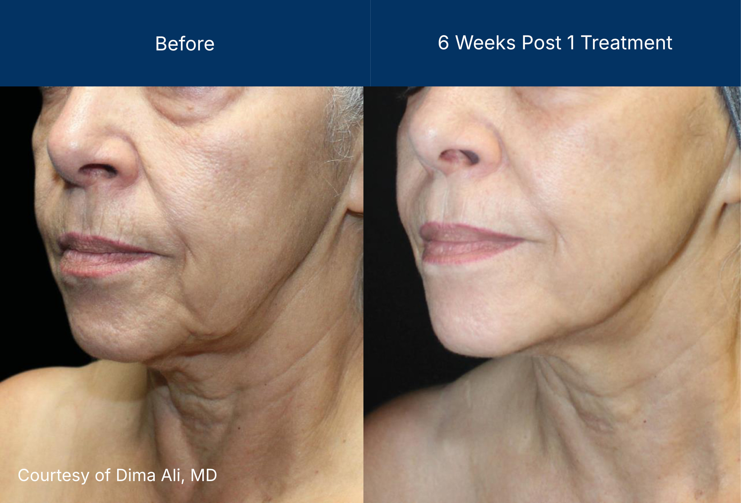 Ultraclear before and after photos