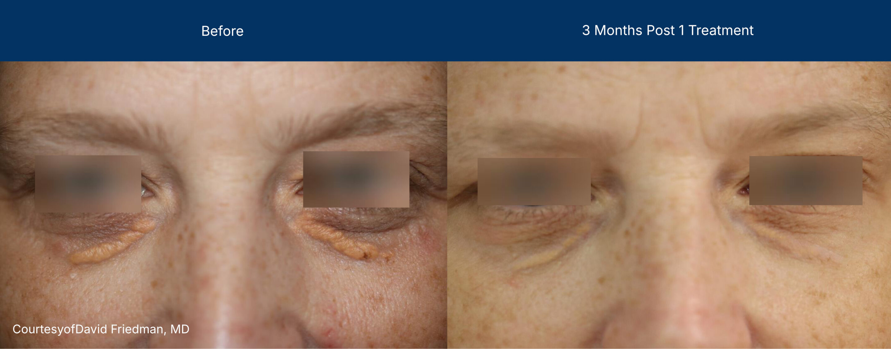 Ultraclear before and after photos