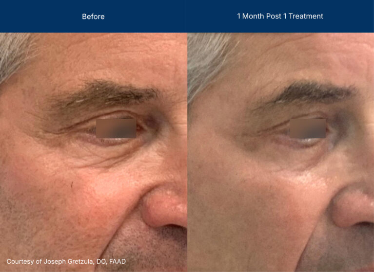UltraClear before and after photos