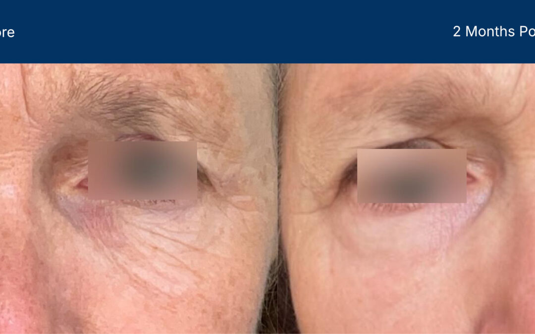 Advanced Treatment with Laser-CoringTM