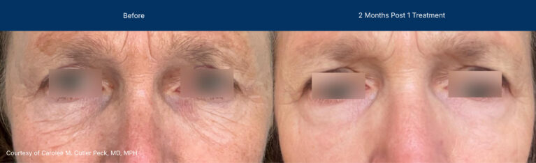 Ultraclear and laser coring before and after photos