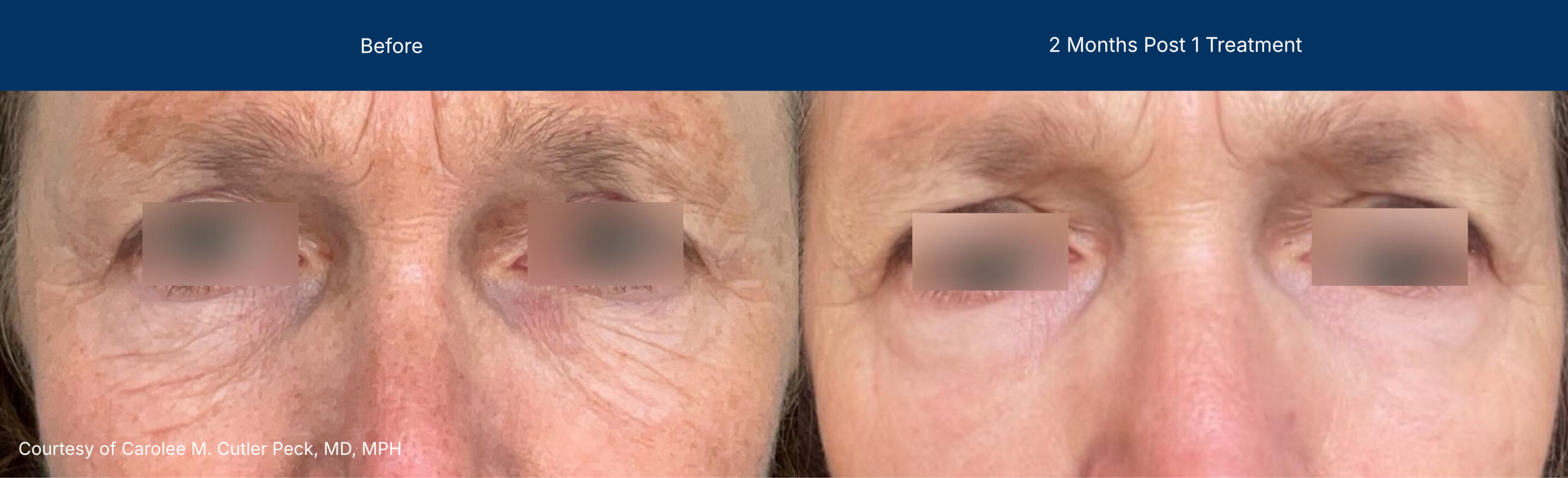 Ultraclear and laser coring before and after photos