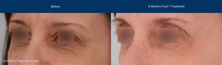 Ultraclear and laser coring before and after photos