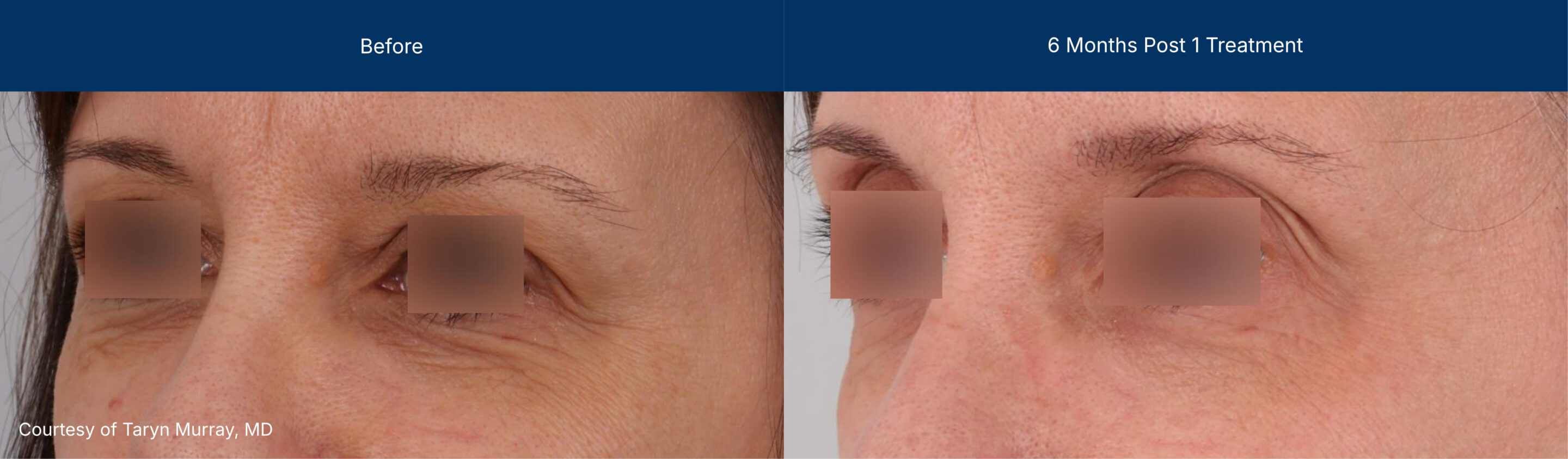 Ultraclear and laser coring before and after photos