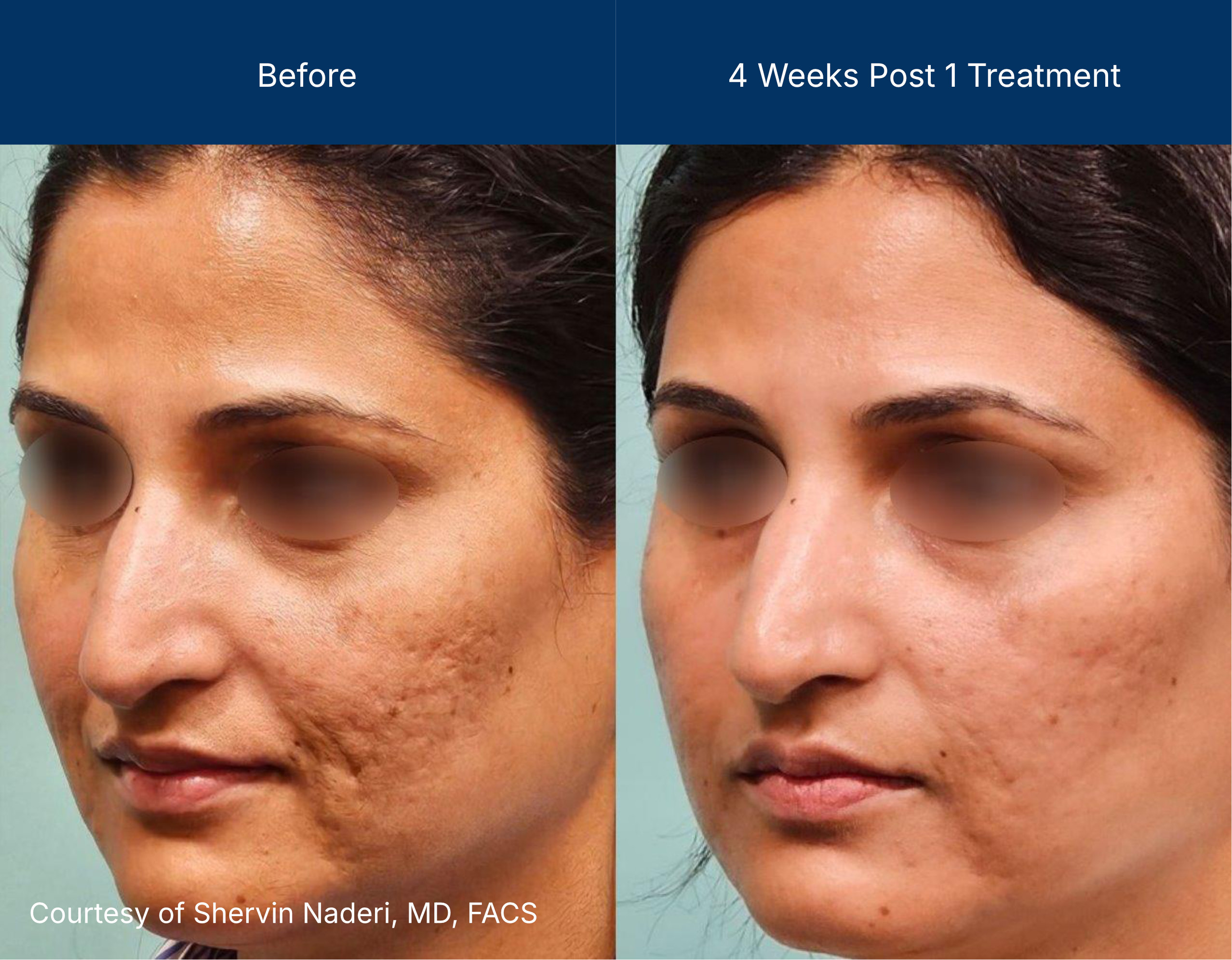 Moderate Treatment before and after photos of a female patient