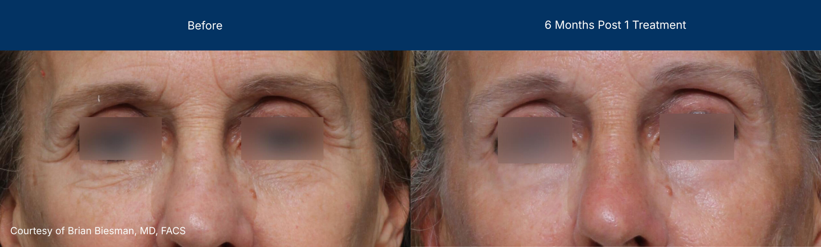 Ultraclear before and after results