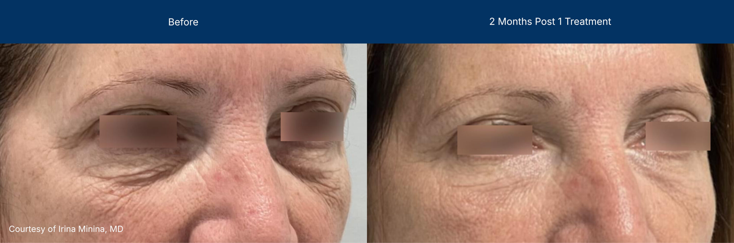 Laser Coring before and after photos