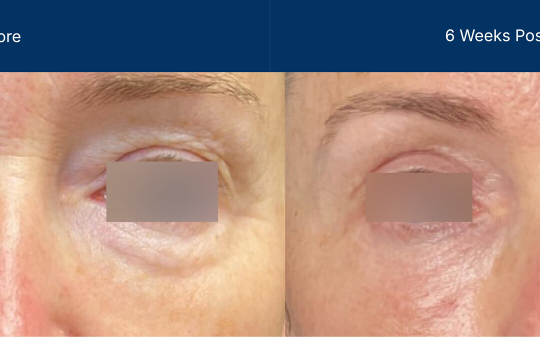 Advanced Treatment with Laser-CoringTM and Surgical Mode Blepharoplasty