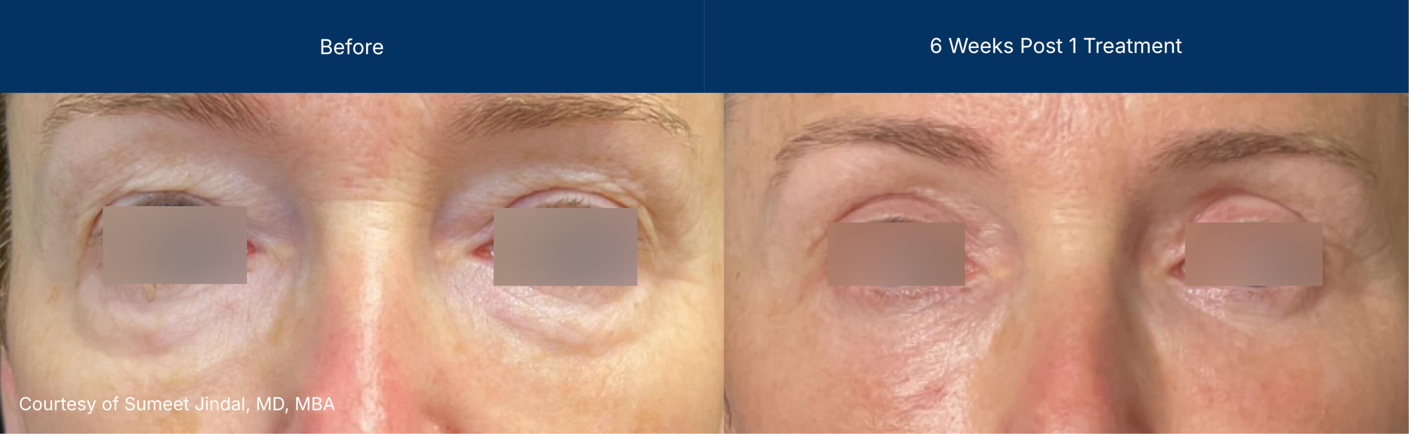 Laser Coring before and after photos