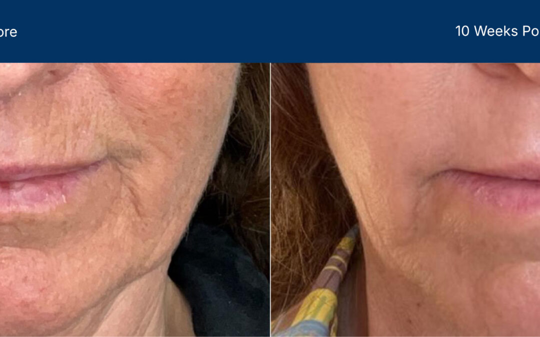 Laser Coring before and after photos