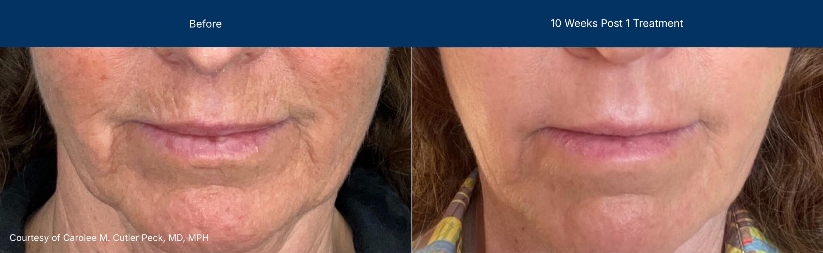 Laser Coring before and after photos