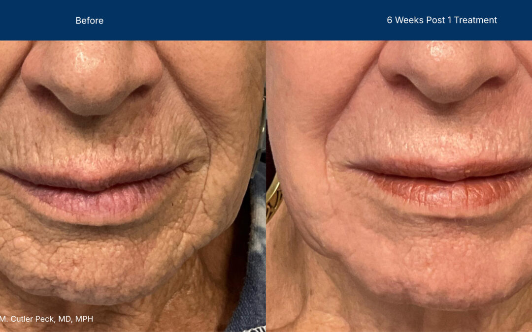 Advanced Treatment with Laser-CoringTM