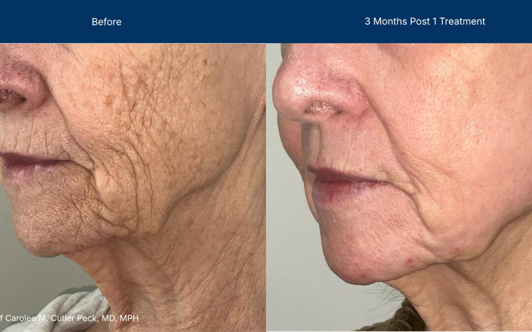 Advanced Treatment with Laser-CoringTM